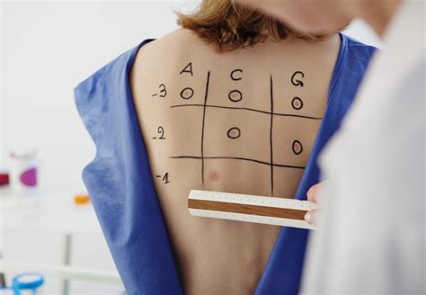 scratch test vs intradermal|Testing and Diagnosis .